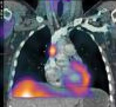 SPECT/CT Catches Metastasis in Thyroid Cancer Early