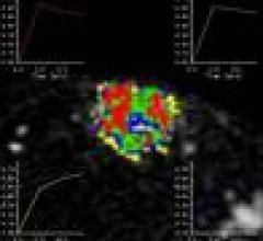 Kinetic Variable Useful for Identifying Malignant MRI-Detected Breast Lesions