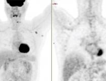 A 63-year-old multiple myeloma patient with skeletal pain showing new FDG PET-CT avid axillary lymphadenopathy 62 days (9 weeks) after second COVID-19 mRNA vaccination dose. The uptake in the lymph node is typical of vaccinated patients, with the adenopathy occuring on the side with the arm that was vaccinated.  Example of axillary adenopathy from the COVID-19 vaccine. Image courtesy of RSNA.