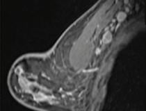 The COVID-19 vaccines have been found to cause adenopathy, inflammation of glandular tissue or lymph nodes, which can show up as a concern on screening mammography. This image shows a 41-year-old woman who underwent high-risk screening breast MRI 15 days after first COVID-19 vaccination dose. Sagittal T1-weighted fat-saturated contrast-enhanced MRI shows extensive unilateral left level I-II axillary adenopathy. BI-RADS 3 was assigned.