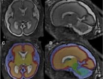 MRI super-resolution reconstruction and atlas-based tissue segmentation. Image courtesy of RSNA