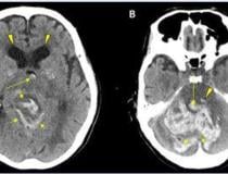 CT showing hemorrhage in a 68-year-old male patient with COVID-19 infection. Image courtesy of RSNA