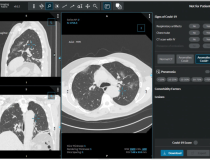 In the STOIC study, readers classified CT exams as COVID positive, COVID negative or normal. The readers had access to the CT scans using a 3-D image visualization web application, allowing scrolling through the entire lung volume in the coronal, sagittal or axial transverse plane. The CT scan shown here has been classified as COVID positive due to the presence of bilateral ground glass opacities and absence of features such as mucoid impaction, bronchiolar nodules, segmental or lobar consolidation. Image c