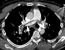 A saddle embolus in a CT scan of a 52-year-old male patient presenting in the emergency department with hypoxia and tachycardia. Image courtesy of Margarita Revzin et al. 