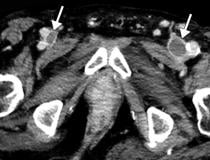 Inferior vena cava (IVC) and peripheral deep vein thrombosis (DVT) in a 78-year-old man with COVID-19 with leg swelling and abdominal pain. Axial contrast-enhanced CT images show filling defects in the bilateral common femoral veins (white arrows).  Image courtesy of Margarita Revzin et al. 