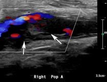 Ultrasound showing popliteal and posterior tibial artery thrombosis in a 58-year-old woman with COVID-19 in the ICU. Sagittal color and spectral Doppler ultrasound images show an echogenic heterogeneous thrombus (white arrows) distending the right popliteal artery. The characteristic knocking or “stump-thump” waveform with absence of diastolic flow and low amplitude imply the presence of occlusion just distal to the area of interrogation. 