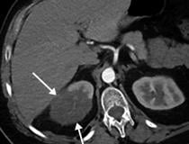 Renal infarct in a 51-year-old man. The patient had a 2-week history of cough and fever and was confirmed to be COVID-19 positive. Axial chest CT angiographic images show the typical appearance of lung changes in COVID-19 pneumonia. Further review of the dataset showed a sharp well-defined area of nonenhancement in the partially imaged upper pole of the right kidney, a finding indicative of a renal infarct (arrows). COVID causes clot formation throughout the body in some patients, leading to organ infarcts.