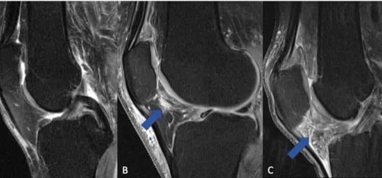 Figure 1. The fat pad adjacent to the kneecap (Hoffa's fat pad, infrapatellar fat pad) can change in signal on MRI when the knee is inflamed. (A) Normal knee without signs of inflammation. (B) Arrow pointing on a circumscribed area with higher signal (bright lines) in the area of the fat pad (normally dark), which is indicative of a beginning inflammatory reaction. (C) The whole fat pad has a higher signal (light grey color with white lines), which is a sign of progressive inflammation of the knee joint.