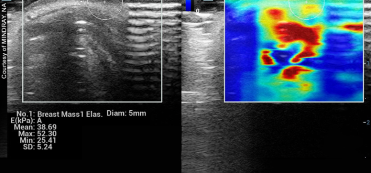 Ultrasound offers a supplemental scan and peace of mind in its ability to find the pathology and almost instantaneously distinguishes a benign cyst from a possible or definite cancer