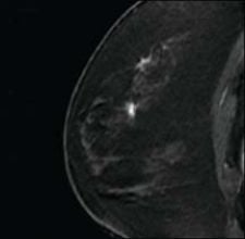 MRI-guided breast biopsy with the Suros ATEC system is viewed as one of the patient follow-up protoc