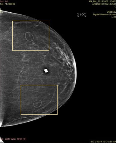 TomoSPOT mole markers used in 2-D portion of 3-D exam with large benign calcification.