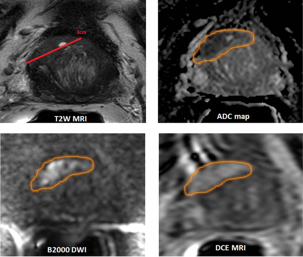 Our initial experiences with mpMRI-ultrasound fusion-guided prostate biopsy