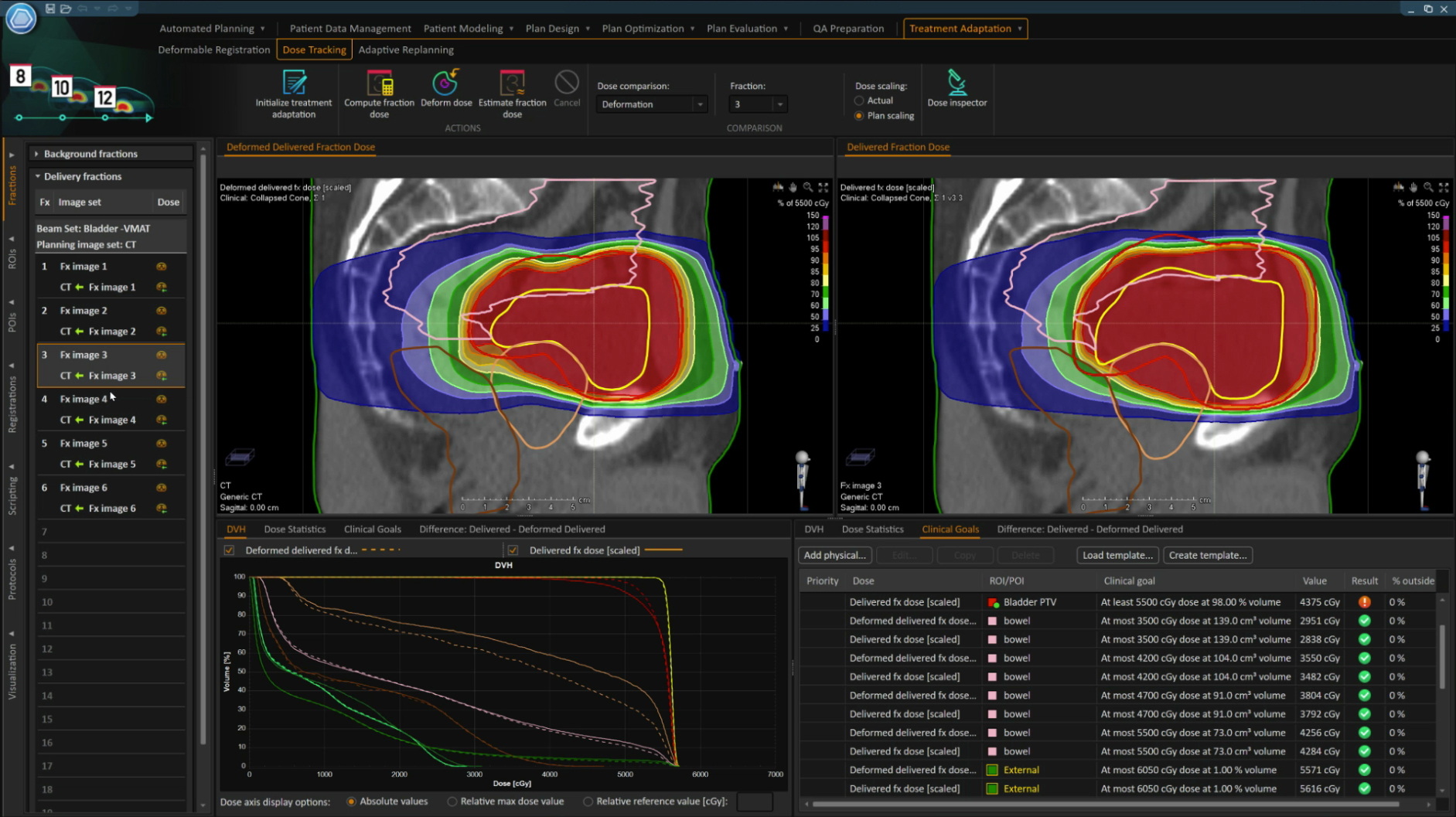 Treatment planning in RayStation