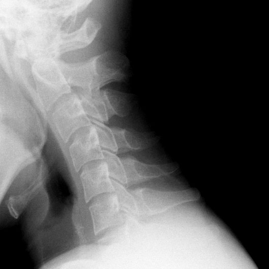 Using DDR, clinicians can visualize the spine or joint, such as the shoulder, while in motion. (Not shown) DDR can also be used to visualize pulmonary respiration and diaphragmatic excursion, such as the movement of the diaphragm, lungs and chest wall during breathing.