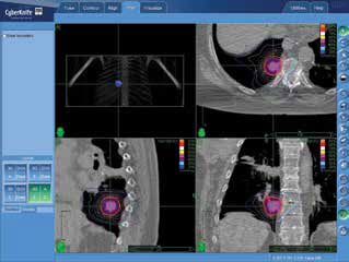 A 3-D, axial, sagittal and coronal view of the treated areahighlighted in pink, as well as radiation dose shown in multicoloredisodose lines.