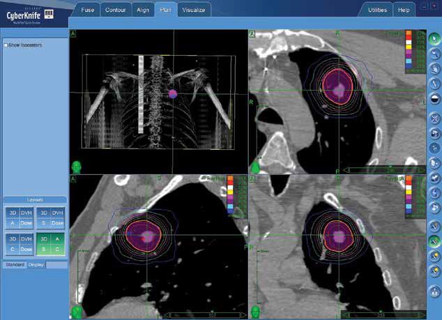 A 3-D, axial, sagittal and coronal view of the treated areahighlighted in pink, as well as radiation dose shown in multicoloredisodose lines.