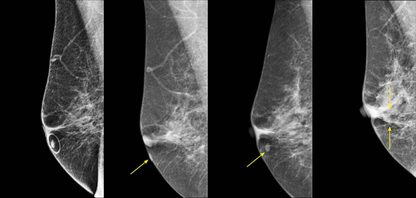 Figure 1. R MLO view from four different years. The skin mole is marked with a circular skin marker (TomoSPOT REF# 782, Beekley Medical) on the far-left image. These images demonstrate the potential for significant variability in location of the skin lesion due to movability of the skin during positioning. 