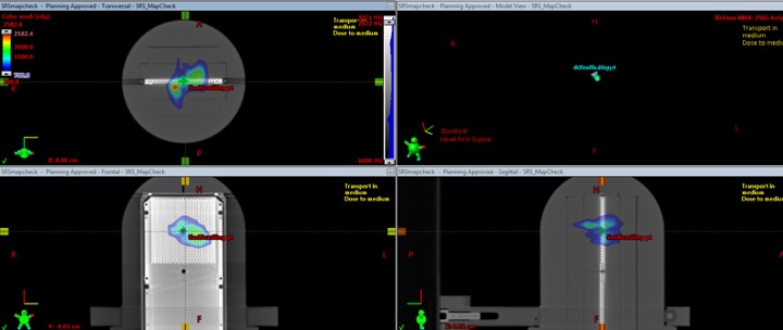 Figure 2: SRS MapCHECK software image of lesions in different planes