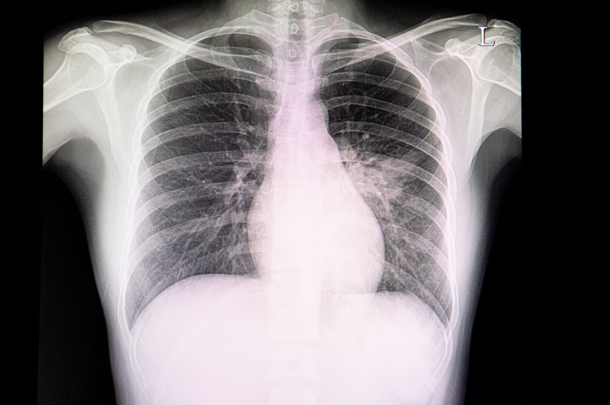 New Research Finds Chest X Ray Not Reliable Diagnostic Tool For