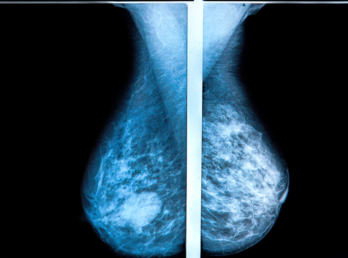 Fewer Breast Cancer Cases Between Screening Rounds with 3-D Mammography - Vimarsana News