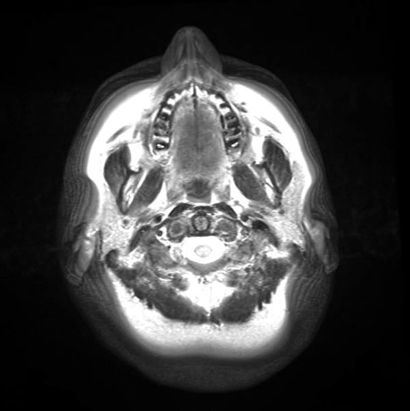 High Strength Mri May Release Mercury From Amalgam Dental Fillings Imaging Technology News