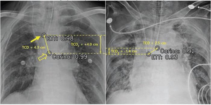 Sztuczna inteligencja potwierdza umieszczenie rurki dotchawiczej na podstawie zdjęcia rentgenowskiego klatki piersiowej