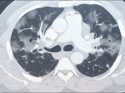 What does COVID look like on X-ray, CT, medical imaging? Radiologic presentations of COVID-19. An example of a COVID-19 pneumonia of a chest CT scan. The COVID appears as white ground glass opacities (GGOs) in the lungs. Normal lungs on CT should appear black. #COVID #COVID19 #Coronavirus