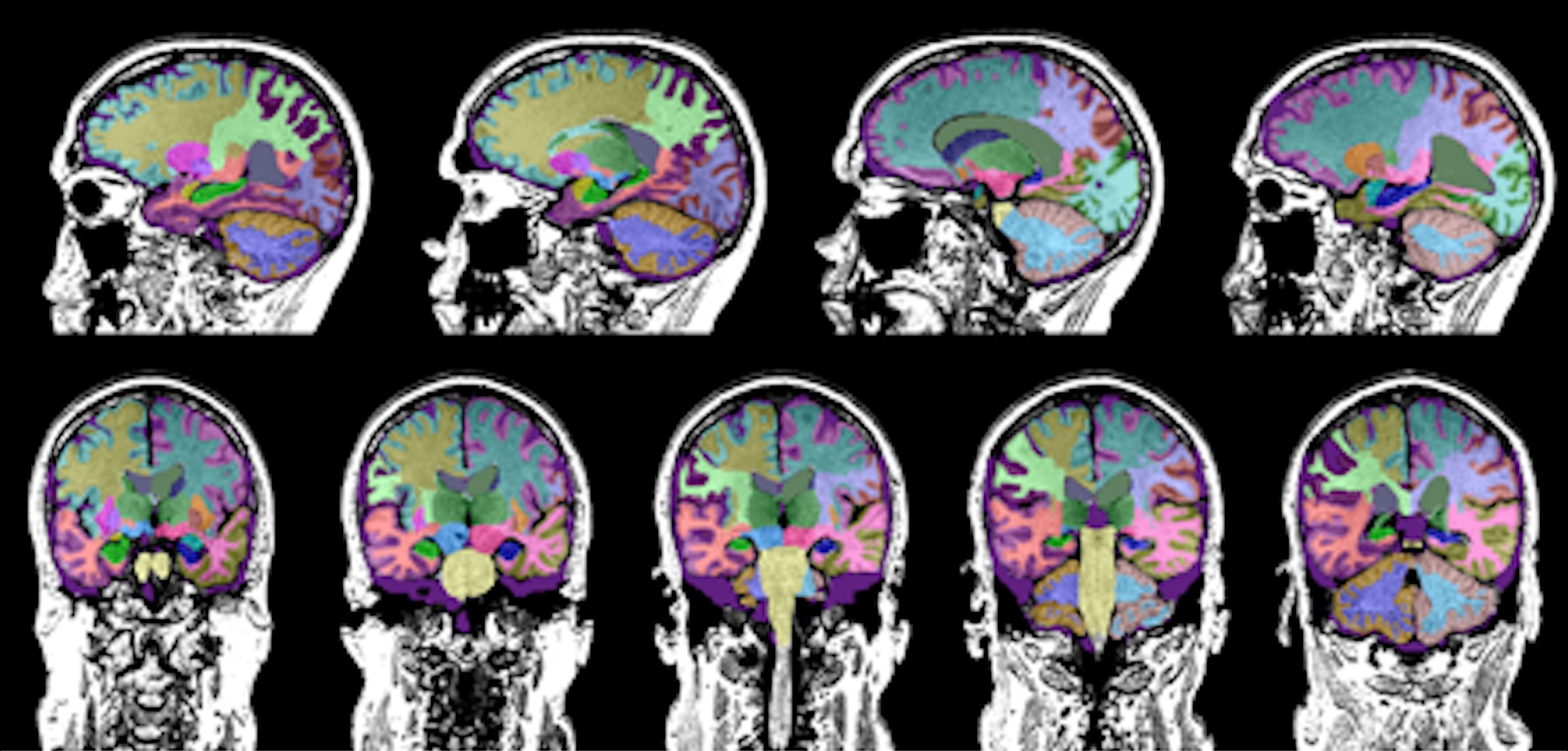 The Neuroreader software program quantifies brain volume in study participants with TBI