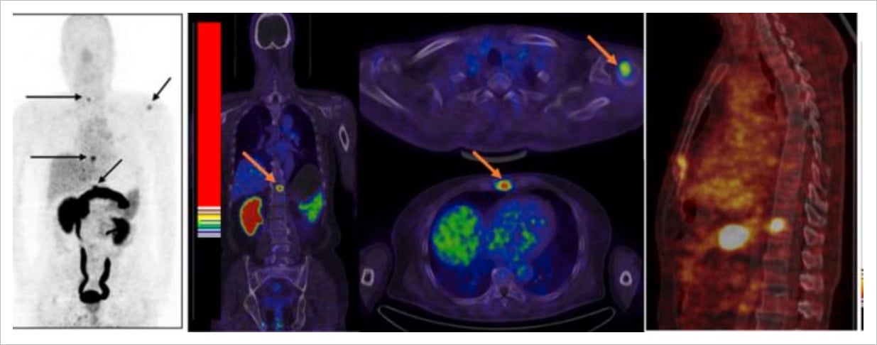 PET CT prostate cancer metastases gallium68 from Peking Union Medical College