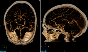 A low-dose neuro CTA using a Philips Ingenuity CT.
