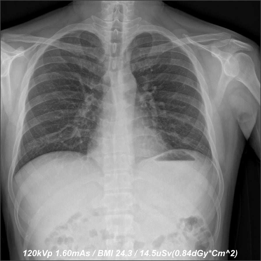 The images (before and after) depict a 50 percent dose reduction in chest X-ray without compromising  image quality.