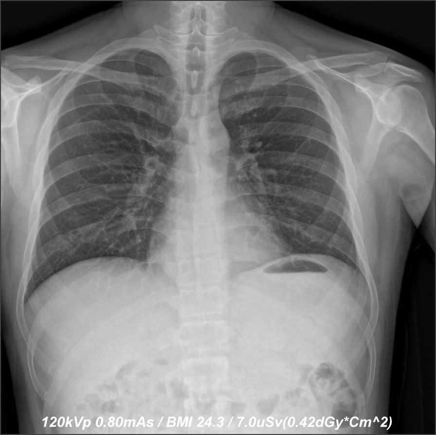 The images (before and after) depict a 50 percent dose reduction in chest X-ray without compromising image quality.