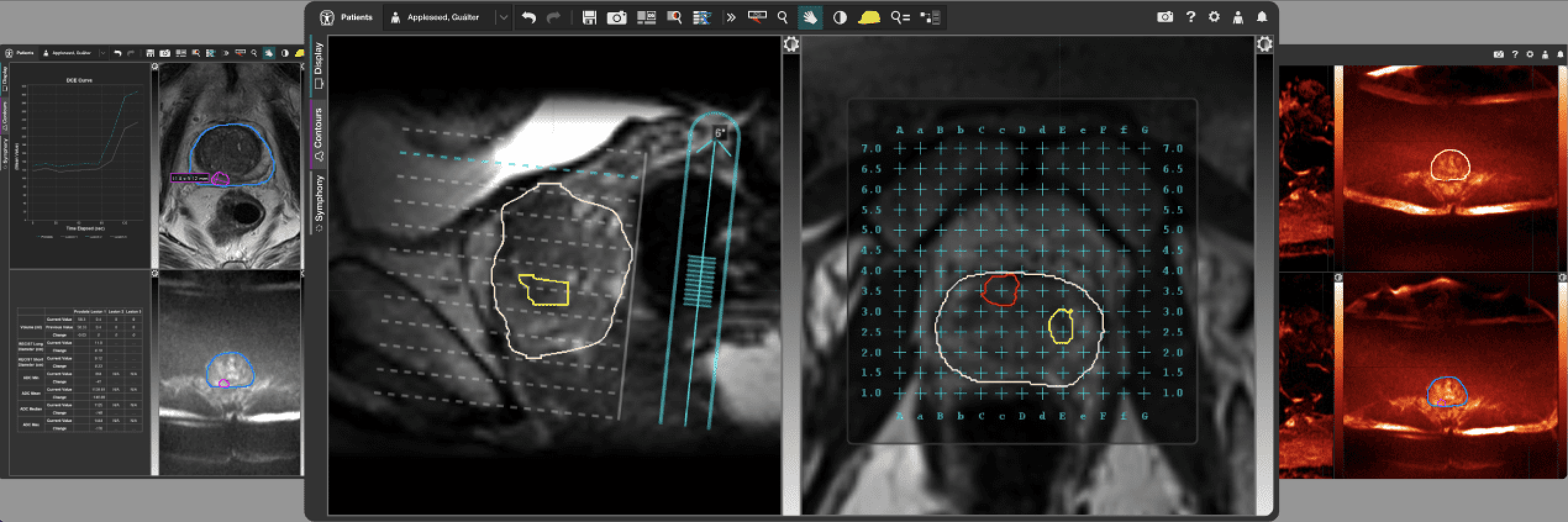 GE HealthCare’s MIM Software Introduces MIM Symphony HDR Prostate for MR Image Guidance During Procedures