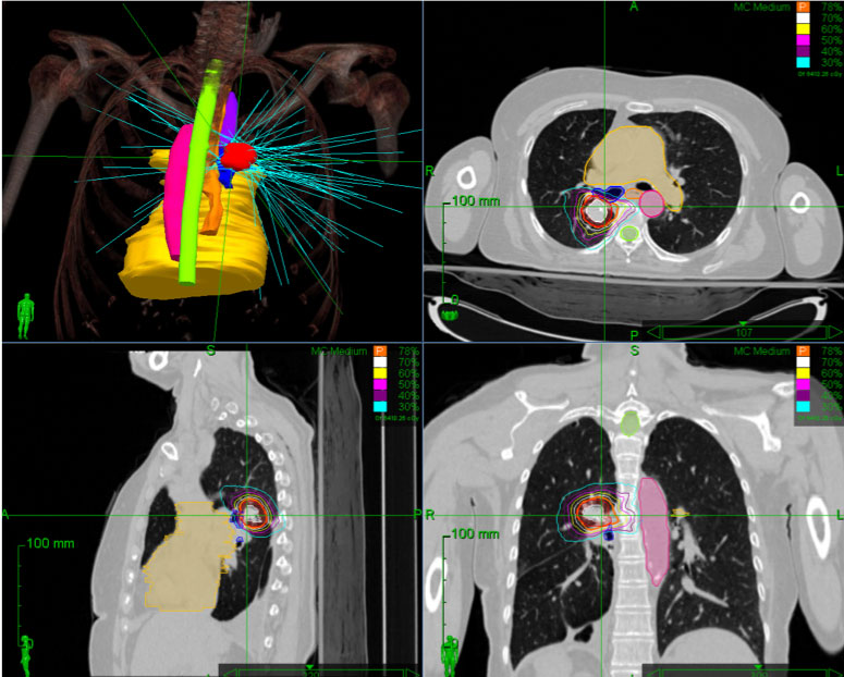 Study Finds Stereotactic Body Radiotherapy Safe for Treating Patients with Multiple Metastases - Vimarsana News