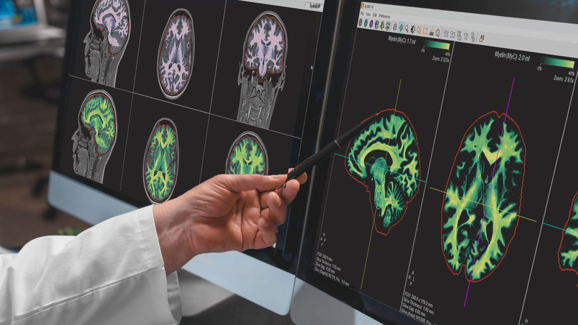 SyntheticMR Receives FDA 510(k) Clearance for its Next Generation Solution SyMRI 3D - Vimarsana News