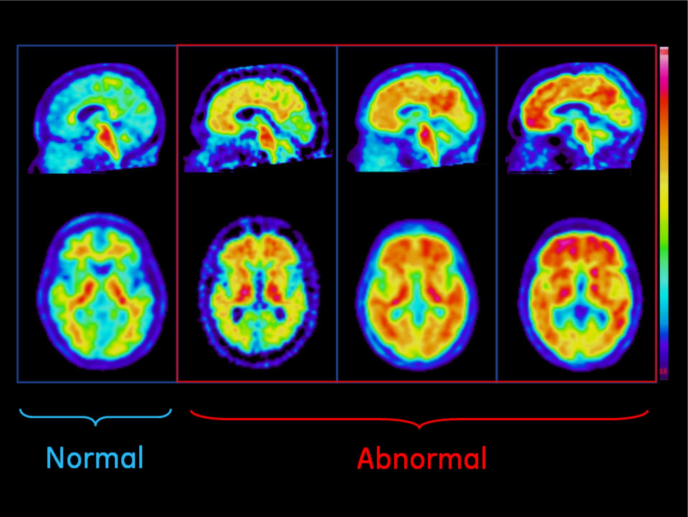 Brain scan