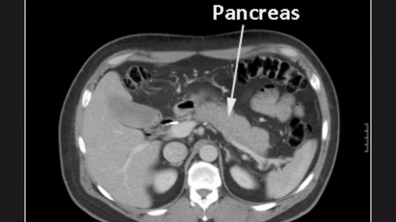pancreatic cancer ct