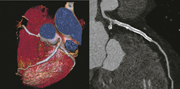 Low dose imaging performed on the Somatom Force