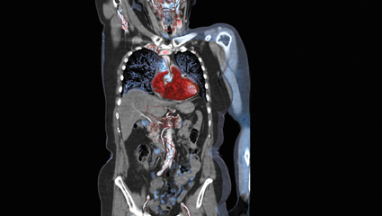 Low dose imaging is performed on the Somatom Force