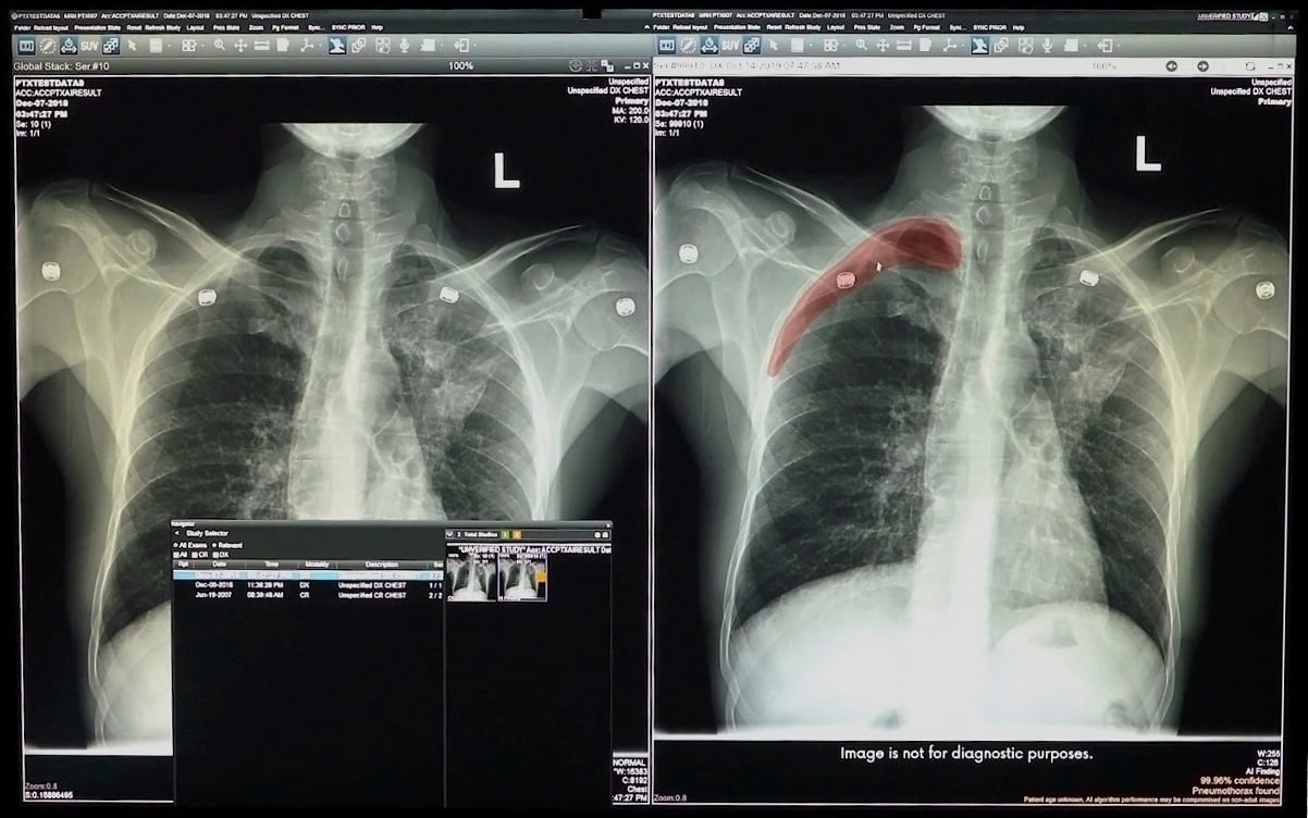 Highlighted region (red) includes signs of pneumothorax on a chest radiograph enhanced by a smart algorithm embedded in GE Healthcare’s Edison Open AI Orchestrator. (CE mark version of software; not commercially available in United States). Screenshot by Kirk Graczyk