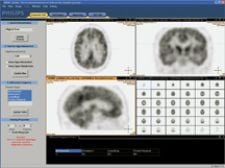 MR-PET Opens New Doors for Neurology