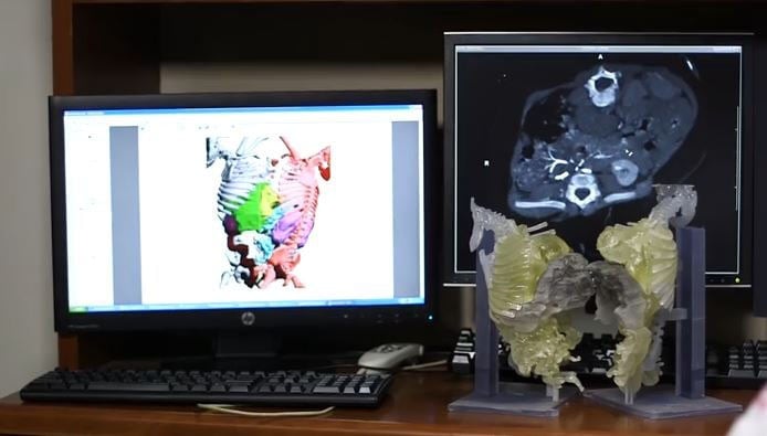 3-D printing, CT dataset, conjoined twins, surgical separation, physical model