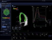 Normal dyssynchrony is demonstrated using Toshibas 3D wall motion tracking for the Aplio Artida ultrasound system. The left ventricle is color coded all green showing timing is in sync, while dyssynchrony would be color coded red.