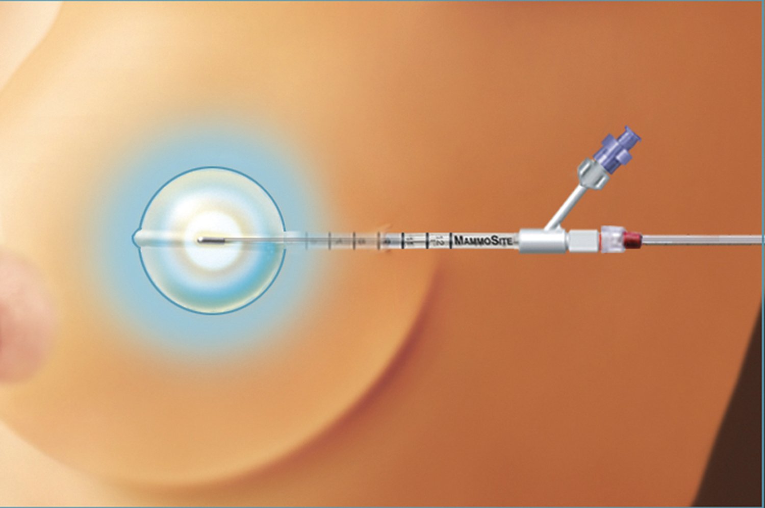 Brachytherapy Systems Women's Health Radiation Therapy