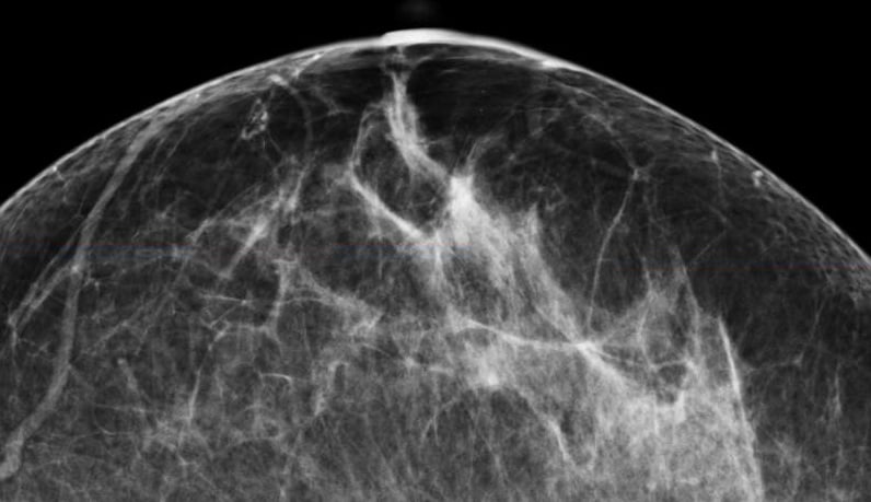 American College of Radiology ACR Society of Breast Imaging SBI Mammography