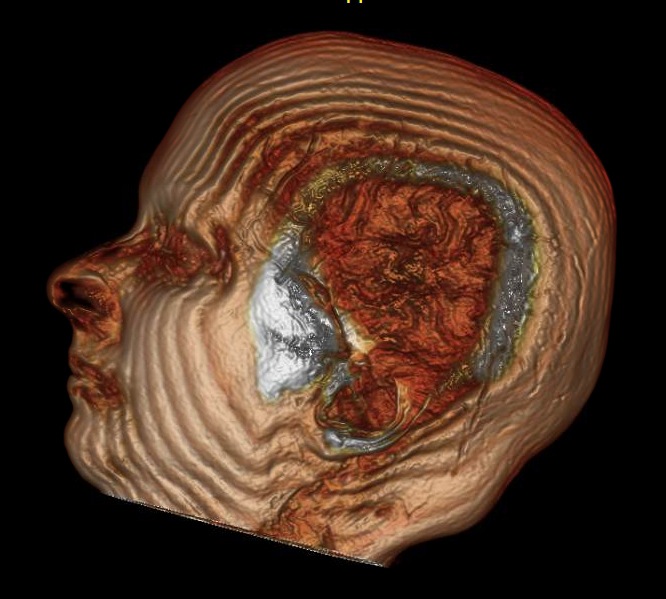 American College of Radiology SGR Imaging Mammography Clinical Decision Support