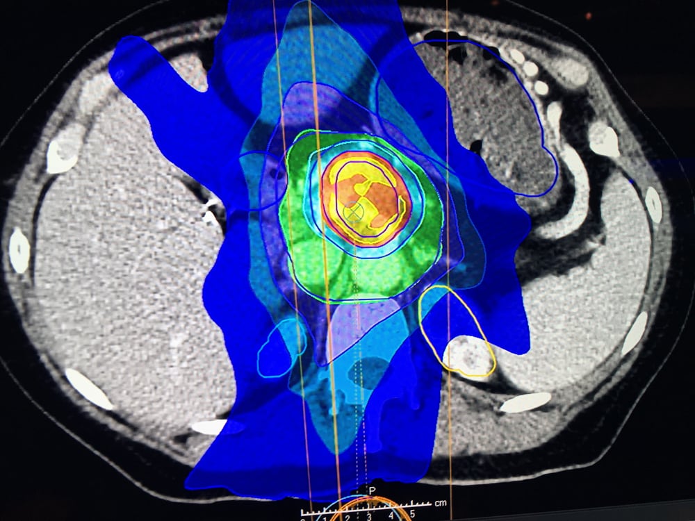 An artificial intelligence (AI) created treatment plan for Pancreatic cancer created by the RaySearch software and displayed at ASTRO 2019.
