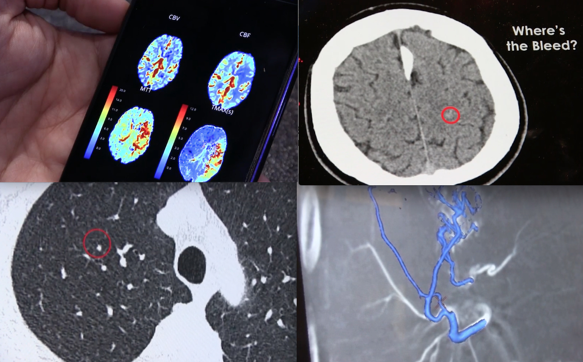 Artificial intelligence (AI) was again the hottest topic in radiology, with 11 of the top 20 pieces of content this month relating to AI. These images are a few of the AI technologies highlighted in ITN Editor's Choice video of the most innovative AI technologies highlighted at RSNA 2018. 