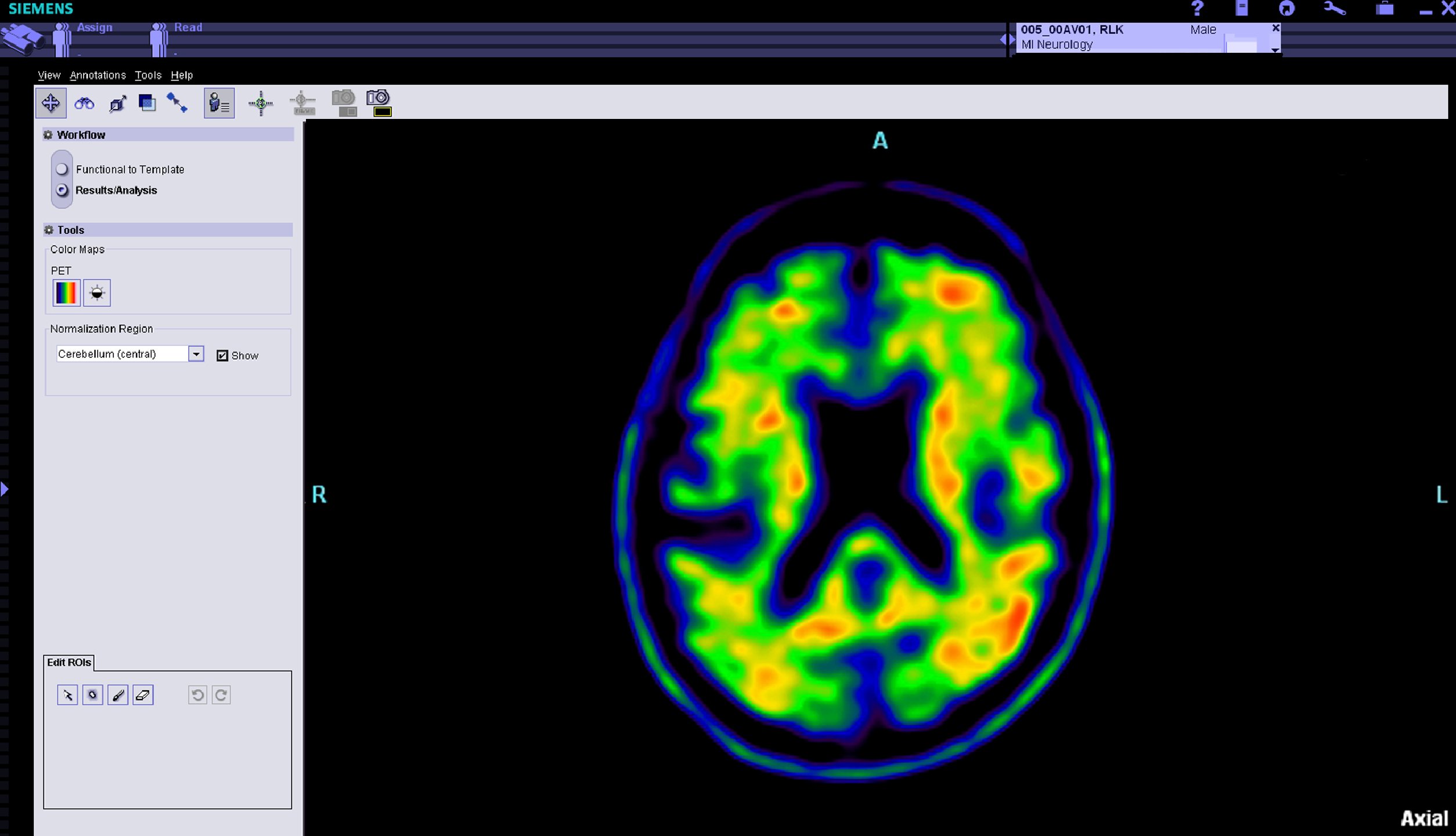 SNMMI Alzheimer's Association Medicare Decision CMS Beta Amyloid PET Coverage
