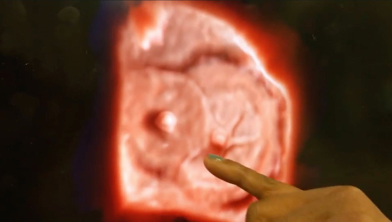 An example of Philips’ TrueVue technology, which offers photo-realistic rendering and the ability to change the location of the lighting source on 3-D ultrasound images. In this example of two Amplazer transcatheter septal occluder devices in the heart, the operator demonstrating the product was able to push the lighting source behind the devices into the other chamber of the heart. This illuminated a hole that was still present that the occluders did not seal.
